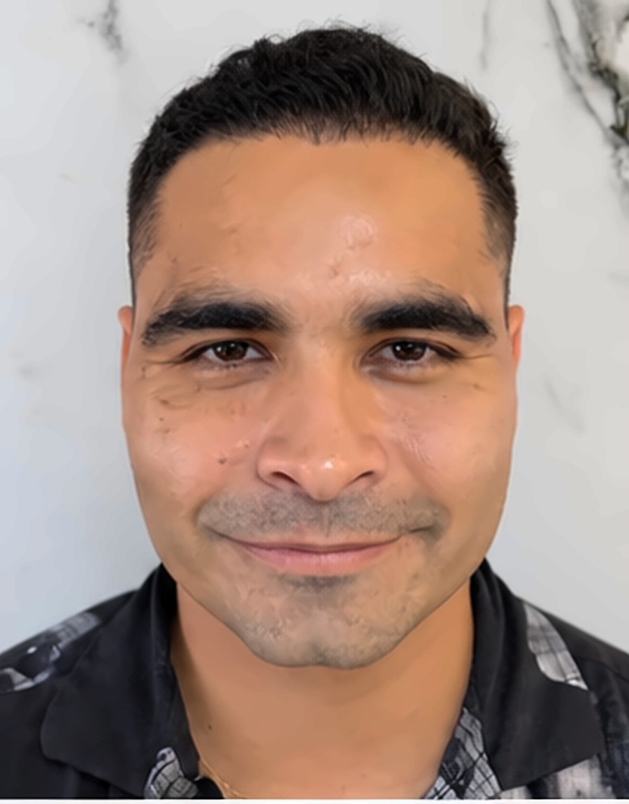 Después: Injerto capilar FUE · resultado a 8 meses