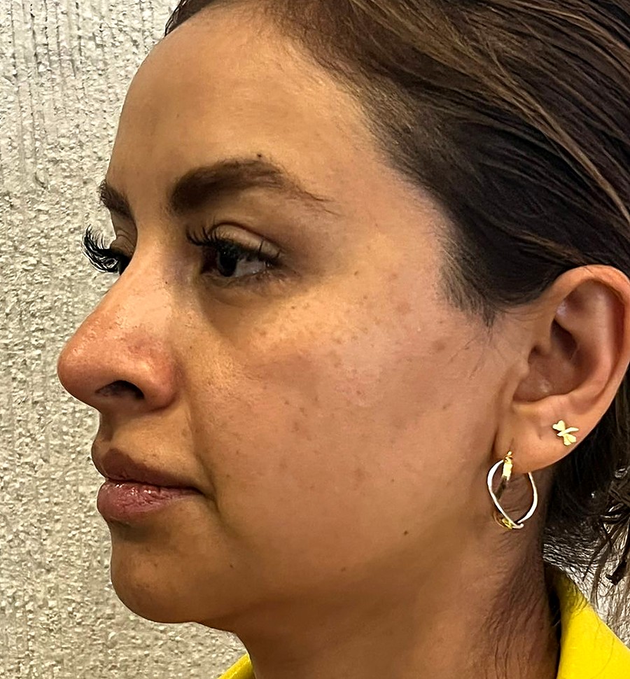 Antes: Endolaser full face