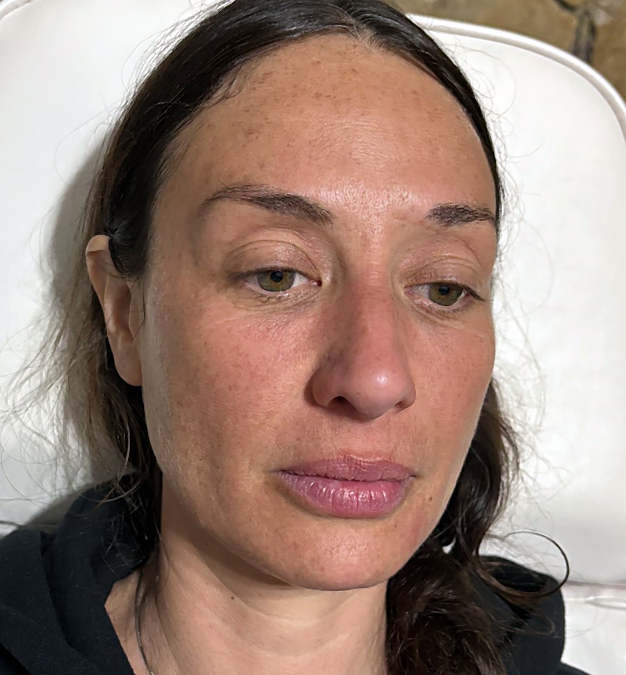 Antes: Labios, perfilado y mentón